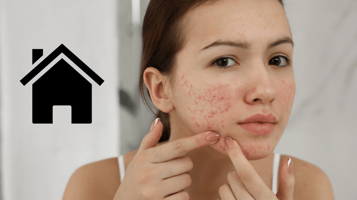 Treat Acne Scars At Home Top Remedies and Tips